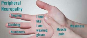 Peripheral-Neuropathy-hand