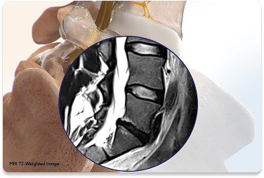 benefits-intracet-procedure-image