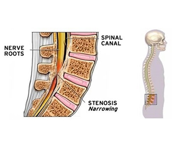 Cervical-Stenosis-image